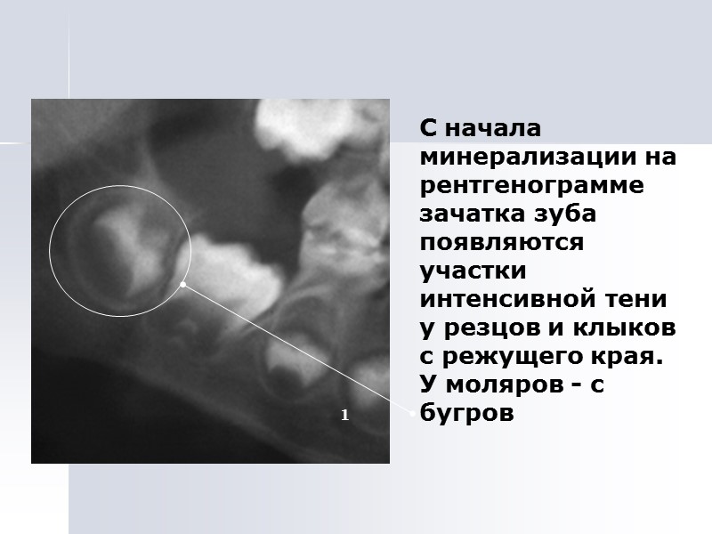С начала минерализации на рентгенограмме зачатка зуба появляются участки интенсивной тени у резцов и